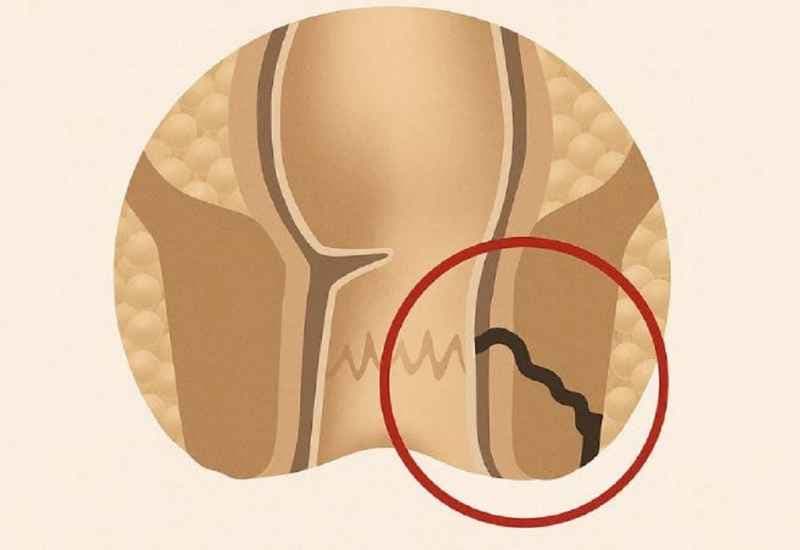 Đường rò thường ngắn, ít nhánh và liên quan đến phần nhỏ cơ thắt hậu môn, chủ yếu hình thành sau nhiễm trùng hoặc áp xe