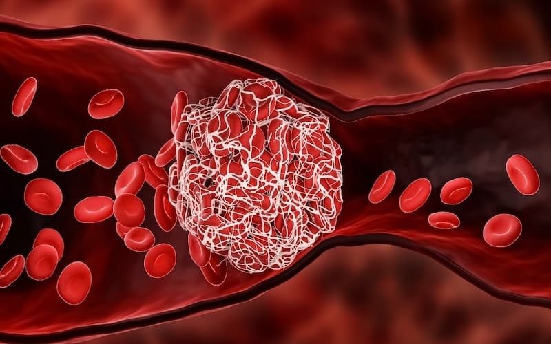 Giãn tĩnh mạch thực quản độ 2 có chảy máu không?