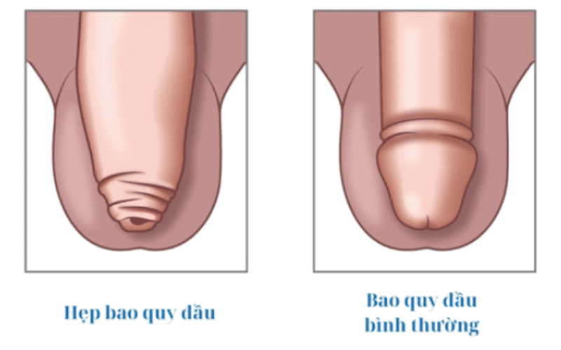 Hẹp bao quy đầu ở nam giới