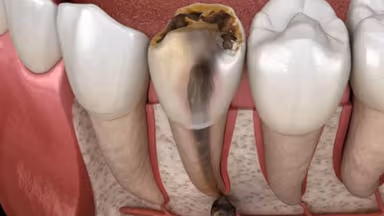 Hoại tử tủy răng: Dấu hiệu, cách điều trị và phòng ngừa
