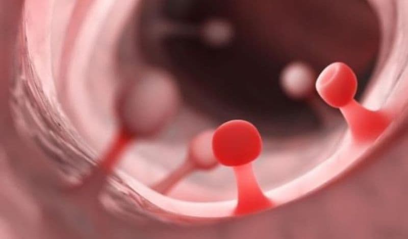 Polyp dạ dày là những khối mô phát triển bất thường từ niêm mạc dạ dày, thường được phát hiện khi nội soi