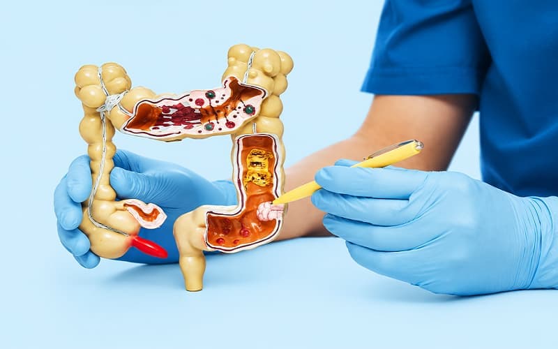 Mức độ nguy hiểm phụ thuộc vào loại polyp đại tràng