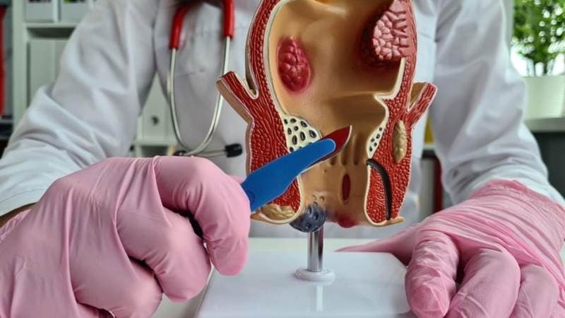 Nguy cơ biến chứng rò hậu môn phụ thuộc vào mức độ phức tạp của đường rò, tình trạng nhiễm trùng và bệnh lý đi kèm
