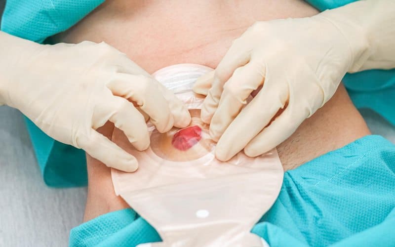 Rò hậu môn tái phát sau mổ là tình trạng đường rò vẫn tồn tại hoặc xuất hiện trở lại tại vị trí phẫu thuật cũ sau khi người bệnh đã được điều trị