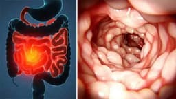 Loét ruột non có tự khỏi không? Khi nào cần điều trị?
