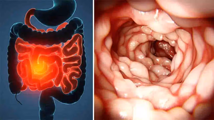 Loét ruột non có tự khỏi không? Khi nào cần điều trị?