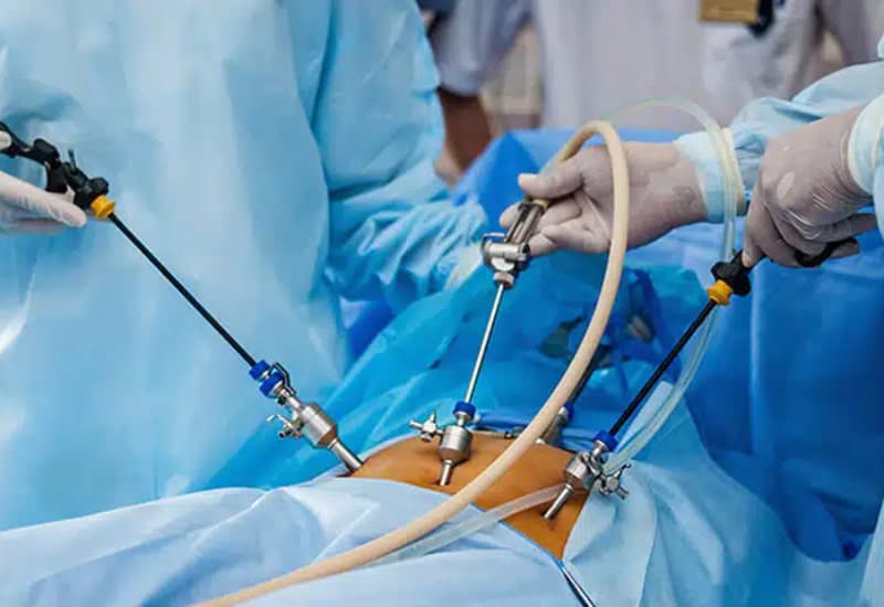 Phẫu thuật nội soi điều trị thoát vị Spigel