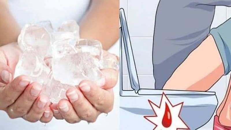 Trĩ chảy máu là tình trạng búi trĩ bị tổn thương, gây chảy máu trong hoặc sau khi đại tiện