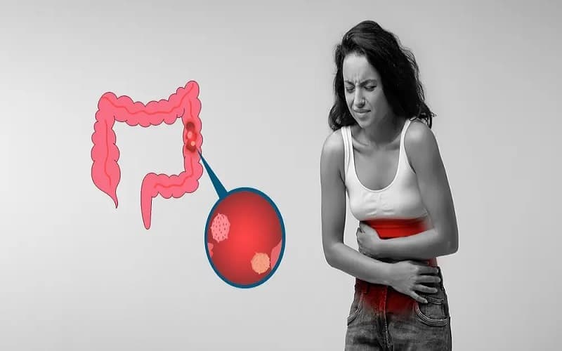 Adenoma ống đại tràng có thể tiến triển thành ung thư
