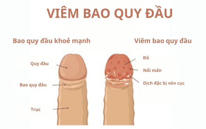 Nguyên nhân bị viêm bao quy đầu tái phát nhiều lần