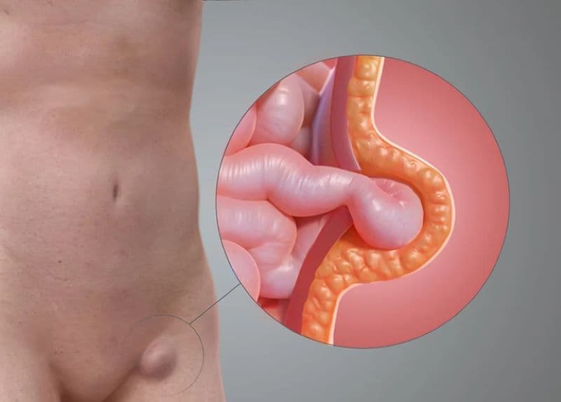Nguyên nhân thoát vị đùi chủ yếu liên quan đến sự suy yếu của thành bụng kết hợp với tình trạng tăng áp lực trong ổ bụng