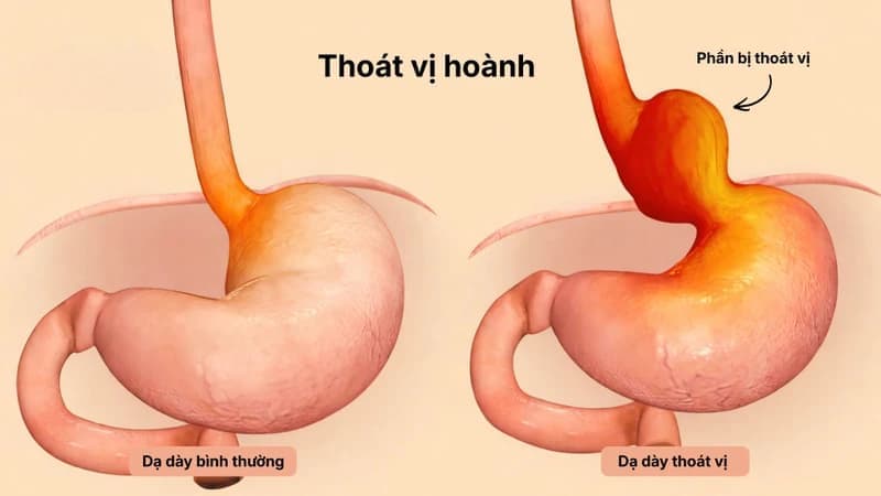 Hình ảnh thoát vị hoành