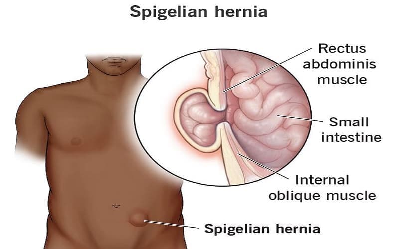 Thoát vị Spigel hay còn gọi là thoát vị bụng bên