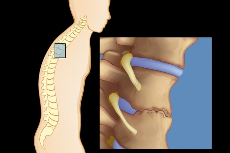 Viêm cột sống dính khớp tổn thương chính tại cột sống, khớp cùng chậu và các khớp chi dưới