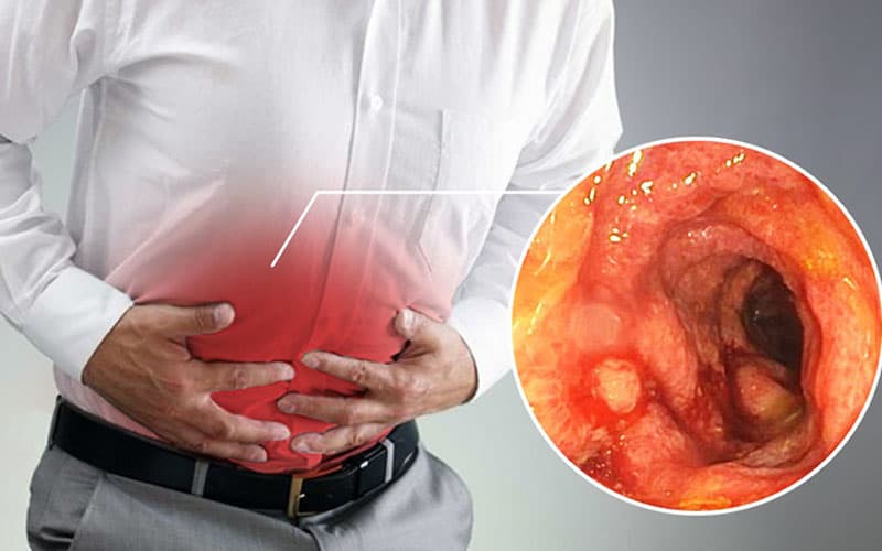 Cơn đau bụng quặn trái đột ngột kèm theo đi ngoài ra máu là dấu hiệu thường gặp