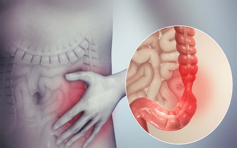 Các triệu chứng viêm loét đại tràng