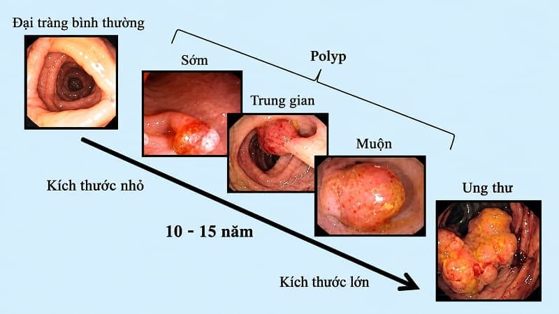 Điều trị polyp đại tràng dựa trên nhiều yếu tố