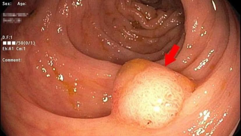 Polyp đại tràng xuống: Nguyên nhân, dấu hiệu, chẩn đoán và điều trị