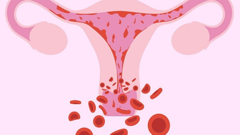 Polyp nội mạc tử cung có nguy hiểm không và cách điều trị