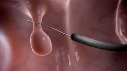 Polyp răng cưa đại tràng là gì? Dấu hiệu, nguy cơ và cách điều trị