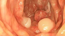 Polyp ruột non có nguy hiểm không? Cách điều trị thế nào?
