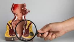 Sa trực tràng là gì? Triệu chứng, cách chữa và phòng ngừa như thế nào?