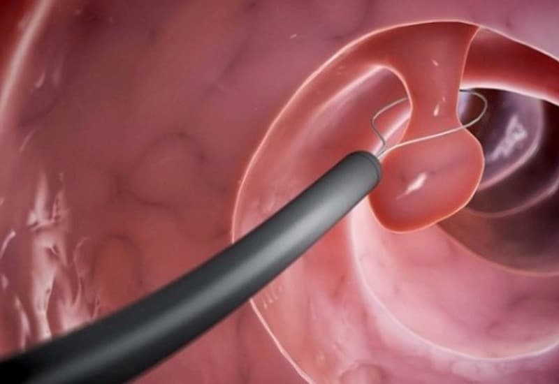 Sinh thiết mẫu polyp đại trạng xuống để tầm soát ung thư