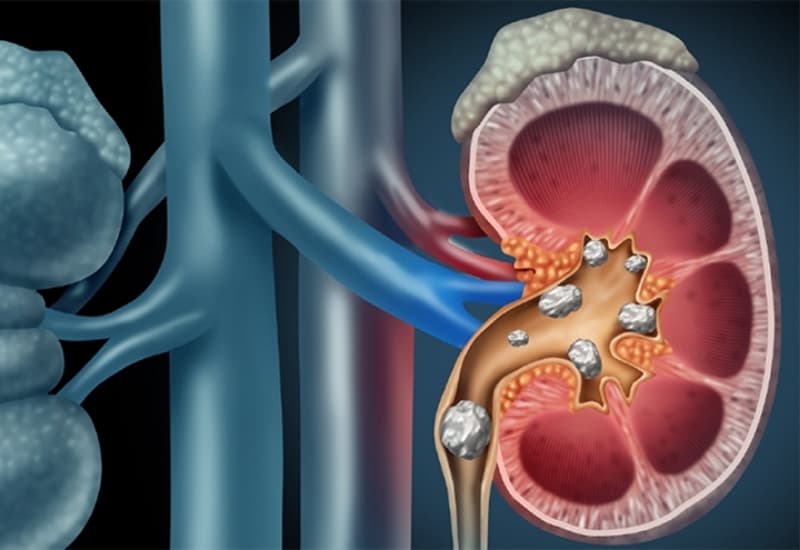 Sỏi bể thận có thể nằm tại hệ thống đài – bể thận và phát triển theo thời gian