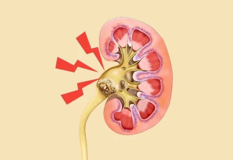 Sỏi gây cản trở dòng nước tiểu có thể dẫn đến tắc nghẽn và thận ứ nước