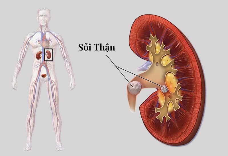 Sỏi gây cản trở dòng nước tiểu có thể dẫn đến ứ nước và ảnh hưởng đến đường tiết niệu