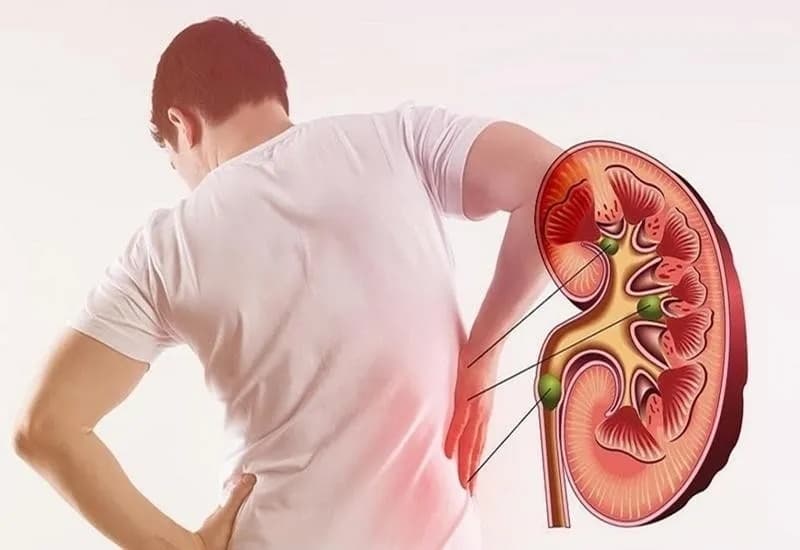 Sỏi thận 6mm có thể gây ảnh hưởng khác nhau tùy vị trí và tình trạng đường tiết niệu