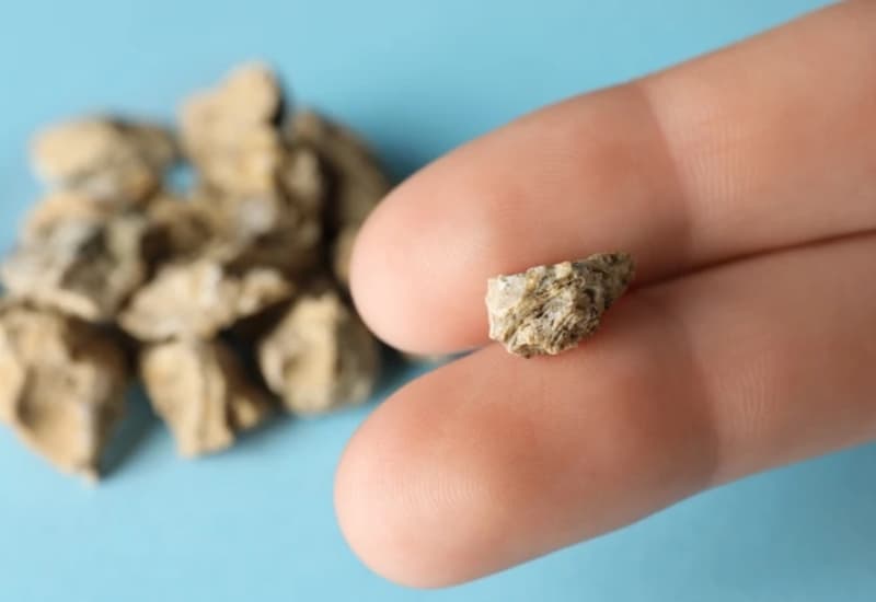 Sỏi thận 7mm có khả năng tự đào thải thấp hơn sỏi kích thước nhỏ