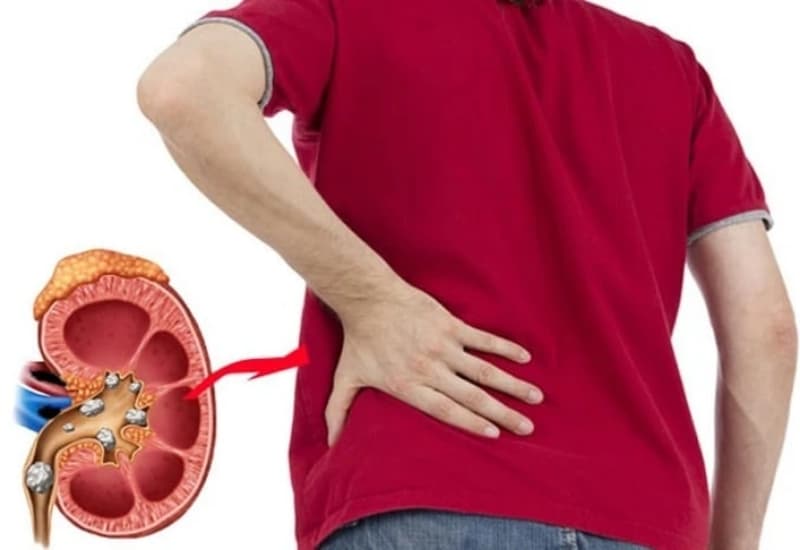 Sỏi thận có thể hình thành khi các chất khoáng trong nước tiểu kết tinh và tích tụ trong thận