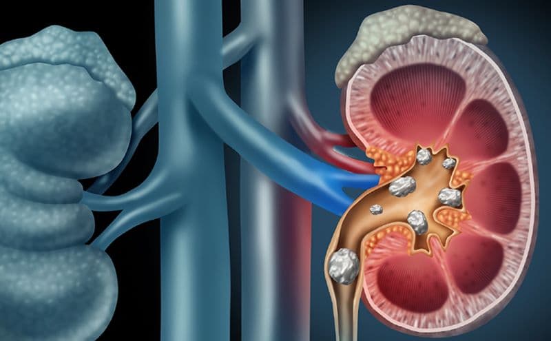 Sỏi thận kèm viêm bể thận là một tình trạng cấp tính nguy hiểm vì sỏi gây tắc nghẽn dẫn đến ứ đọng nước tiểu
