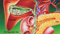 Sỏi túi mật có nguy hiểm không? Cần ăn uống và phòng ngừa thế nào?