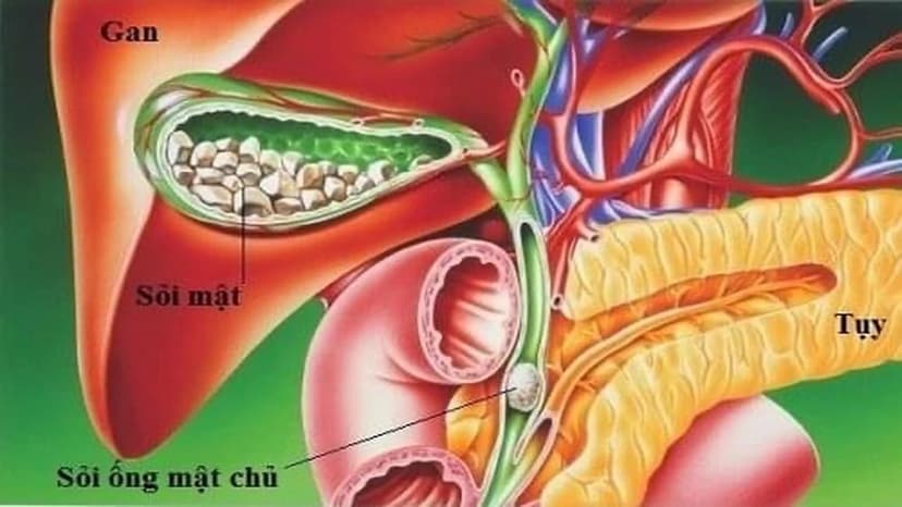 Sỏi túi mật có nguy hiểm không? Cần ăn uống và phòng ngừa thế nào?