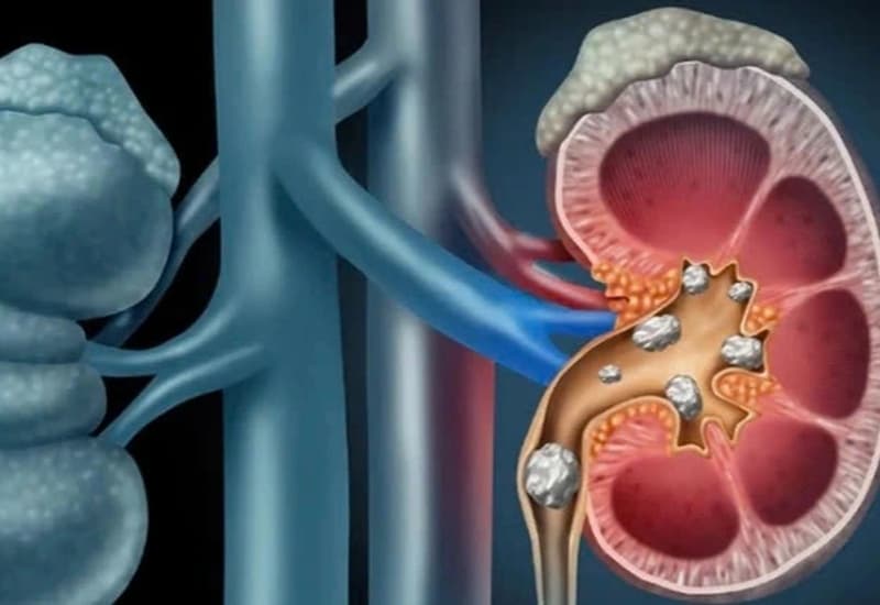 Tắc nghẽn kéo dài hoặc nhiễm trùng do sỏi có thể ảnh hưởng đến chức năng thận