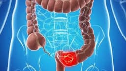 Tắc ruột là gì? Nguyên nhân, dấu hiệu nhận biết và cách điều trị hiệu quả