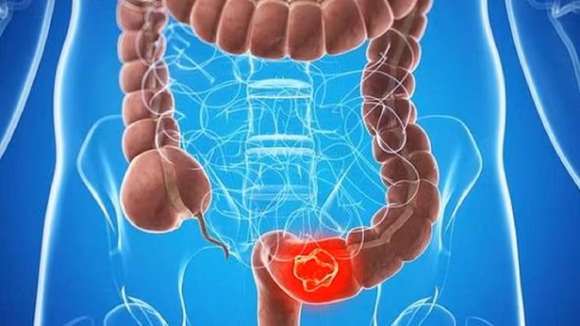 Tắc ruột là gì? Nguyên nhân, dấu hiệu nhận biết và cách điều trị hiệu quả