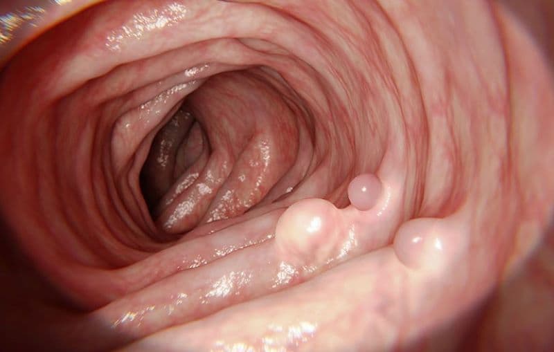 Kích thước polyp dạ dày là một trong những yếu tố bác sĩ cần đánh giá khi nội soi