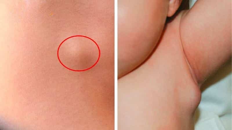 Hình ảnh u bã đậu dưới da