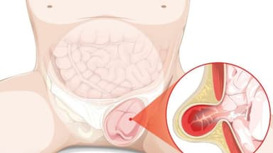 Thoát vị bẹn nghẹt là gì? Nhận biết dấu hiệu nguy hiểm và xử trí ra sao?