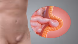 Thoát vị bẹn tái phát là gì? Nhận biết, chẩn đoán và điều trị như thế nào?
