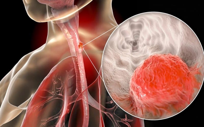 Một vài thông tin chung về ung thư biểu mô tế bào vảy thực quản