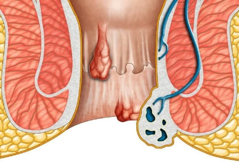 Trĩ hỗn hợp là sự kết hợp của búi trĩ nội và trĩ ngoại