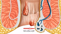 Trĩ hỗn hợp là gì? Dấu hiệu, biến chứng và cách điều trị hiệu quả