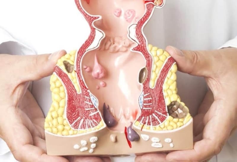 Trĩ ngoại hình thành ở vùng tĩnh mạch phía ngoài hậu môn