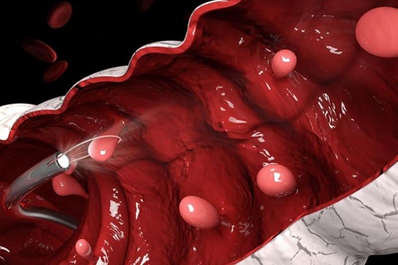 Adenoma nhung mao đại tràng là một dạng polyp tuyến phát triển từ lớp niêm mạc đại tràng