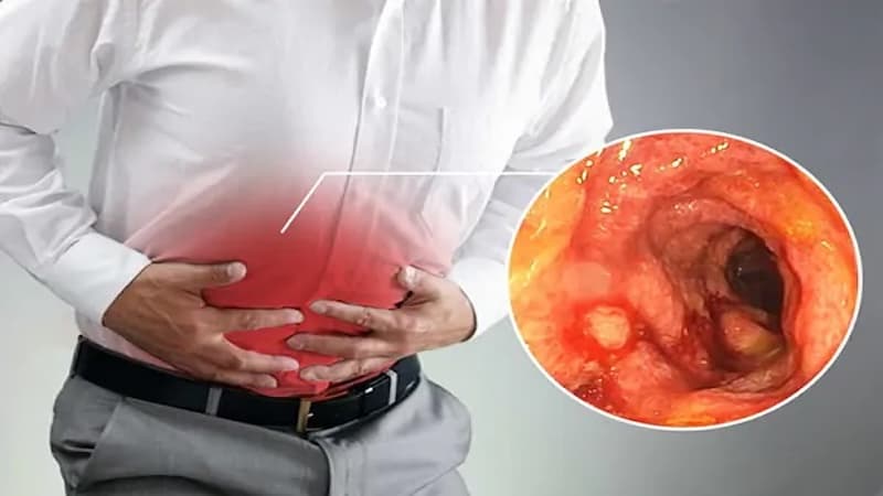 Các triệu chứng viêm đại tràng có thể xuất hiện từ từ hoặc bùng phát theo từng đợt, tùy thuộc vào vị trí và mức độ viêm