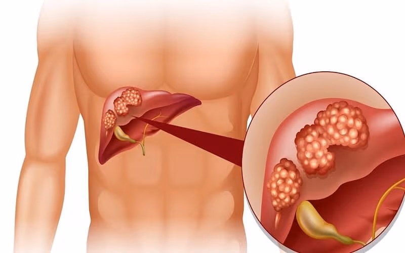 Viêm gan B giai đoạn đầu có những triệu chứng nhận biết nào?